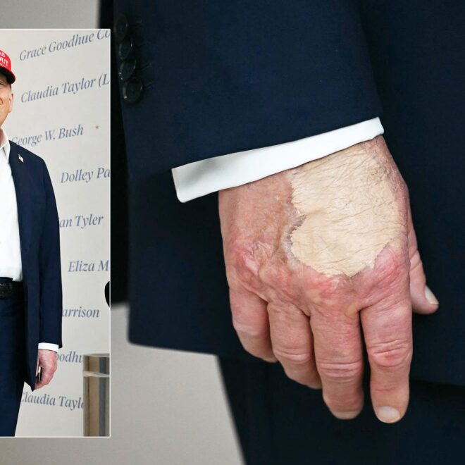 As Health Questions Swirl, Weird Spot Appears on Trump’s Hand