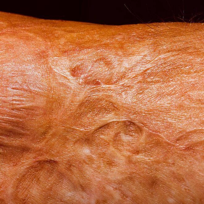 Scientists Intrigued by Cream Designed to Make Old Scars Disappear