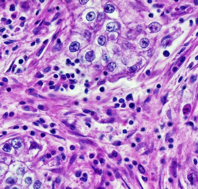 Doctors Catch Cancer-Diagnosing AI Extracting Patients’ Race Data and Being Racist With It