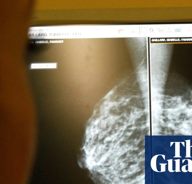 AI use in breast cancer screening cuts rate of later diagnosis by 12%, study finds | Cancer research